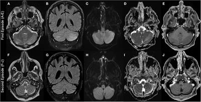 Hypomagnesemia-Induced Cerebellar Syndrome—A Distinct Disease Entity? Case Report and Literature Review